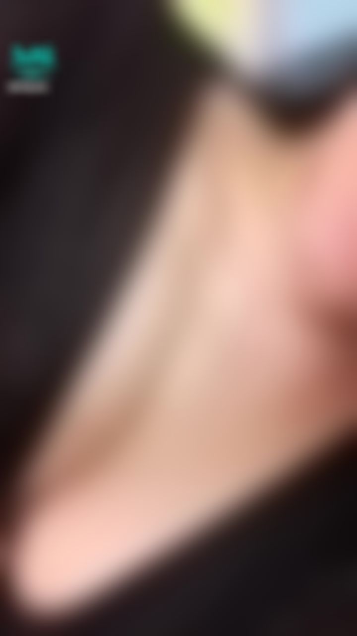 miyyaa : 被蚊子亲了一下～红红的🥺