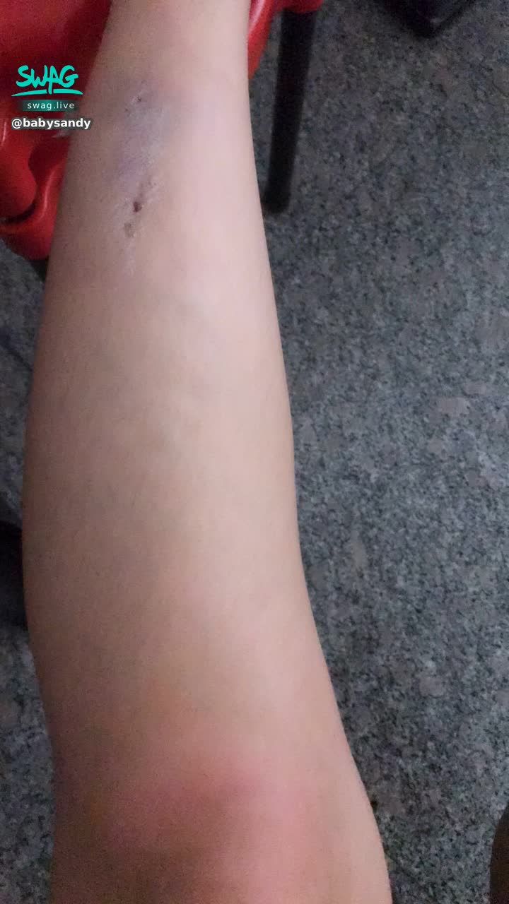  : 一大早就受傷🤕️