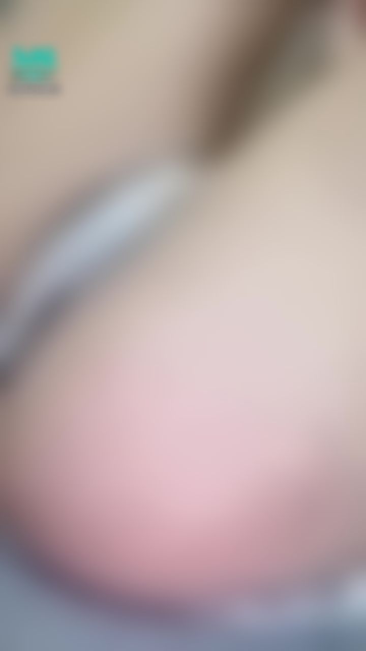 poiqueen : 屁股有胎記真的不太好看