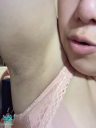 lovemilemile : 這是腋下 鼻子是破皮啦😂😂😂
#腋下 #蜜璃