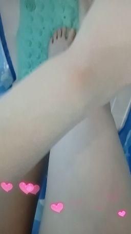 floraof : 唔小心跪一下地下就搞到腳都淤埋（最尾有咩嘢睇🫣