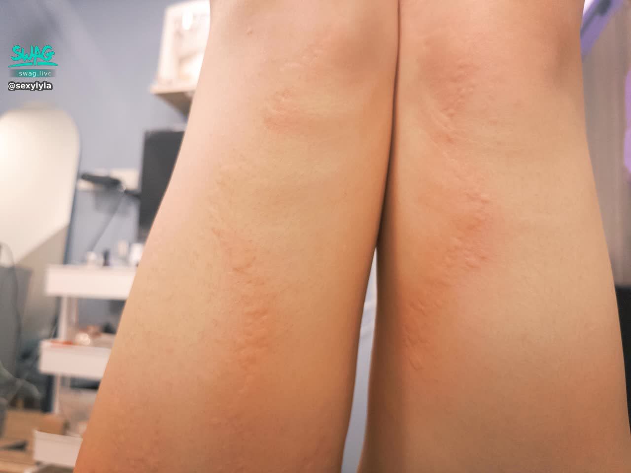 sexylyla : 一早起床就發現急性尋麻疹😭
但因為要上班所以拖到剛剛才去看醫生😞
希望吃了藥 明天就好了😔
不知道為什麼最近身體狀態好差..