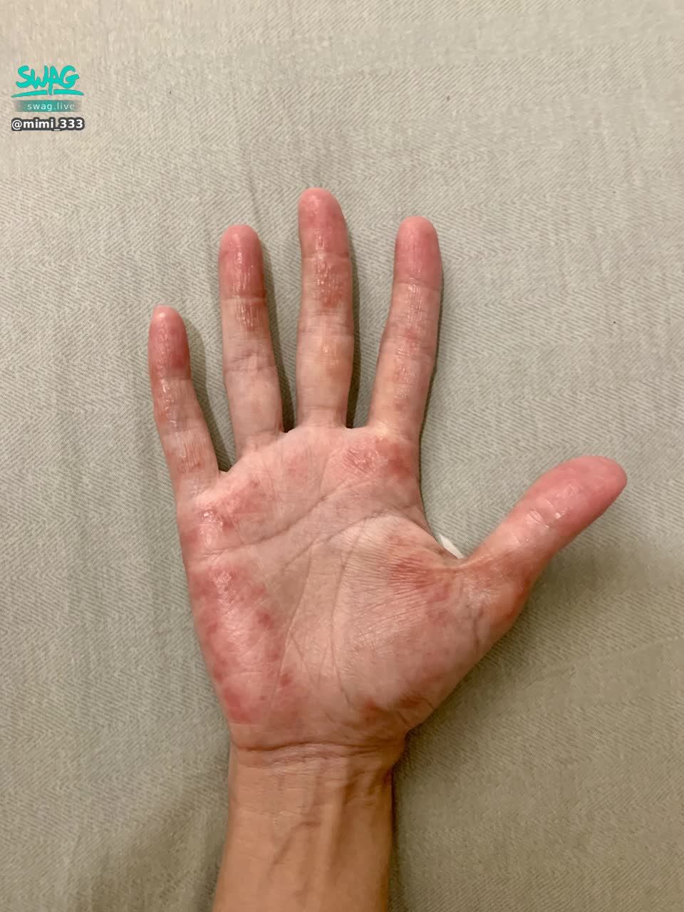 mimi_333 : 我知道照片很嚇人，但也不是24小時都這樣，就是這幾天有很多時刻是這樣

做任何事情都要戴手套，例如刷牙、洗臉，只要不碰水，狀況會稍微好一些些。

但只是也無法保證戴了手套後的悶熱流汗情況不會引起皮膚發炎
所以大概一天會反覆個幾次、但輕重不同

下一篇研究文