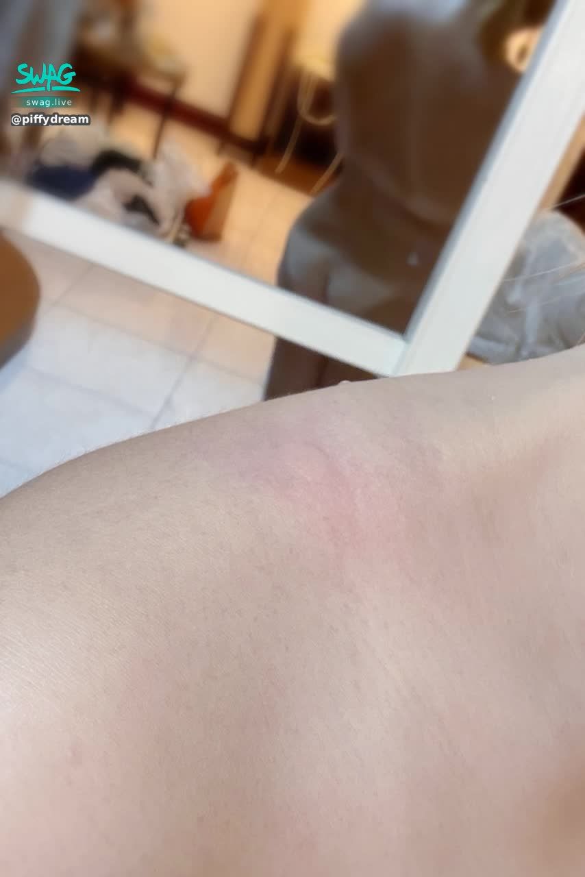 piffydream : 剛剛吹著海風吃著仙草冰
突然覺得肩上一痛
回家之後發現被咬了現在麻麻暈暈的怎麼辦？