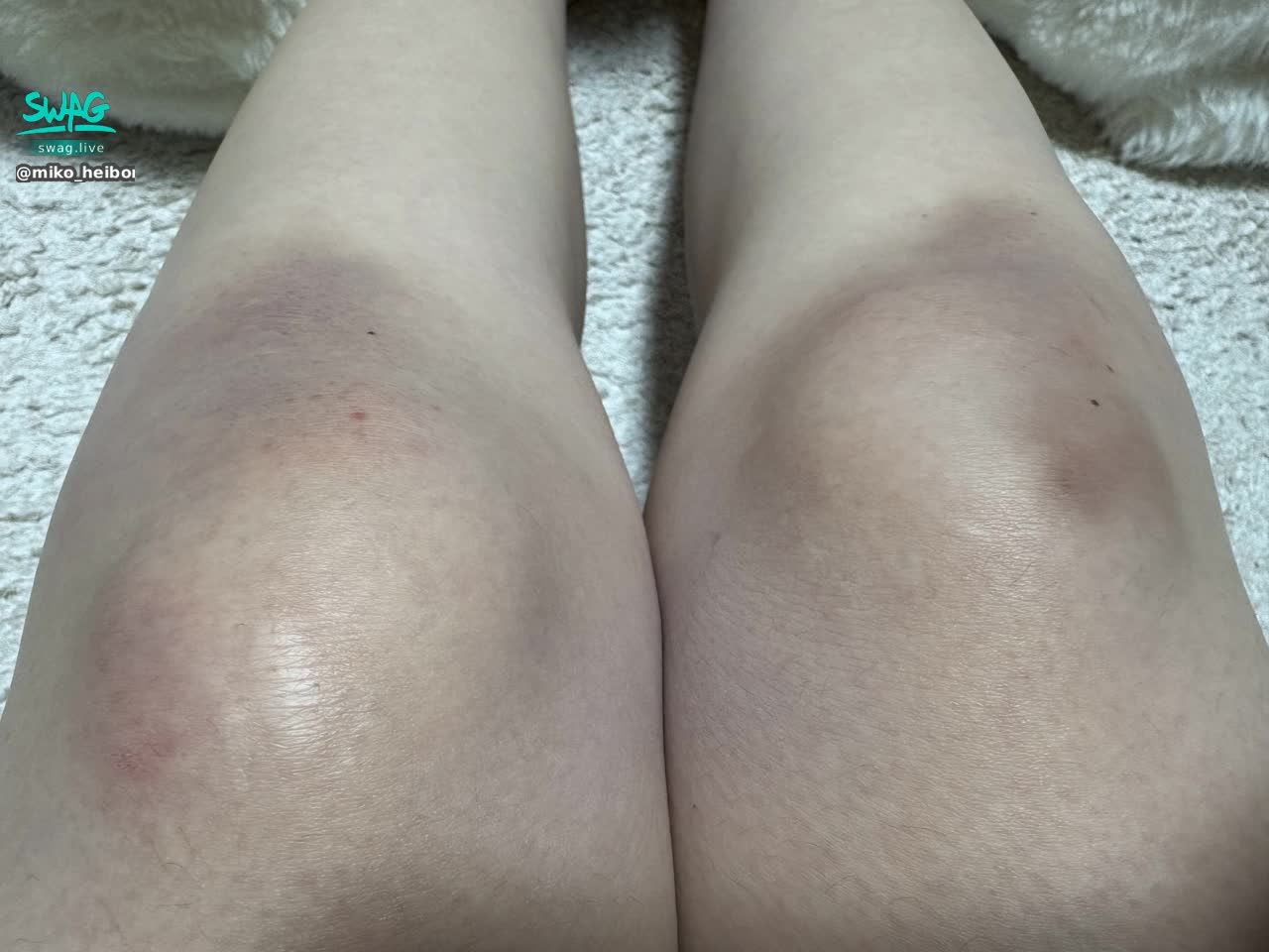 miko_heibonol : After going out for sushi, I fell and hurt my knee 🥺
Please be careful when you go out at night, everyone.
去吃壽司回來的時候不小心跌倒,把膝蓋摔傷了🥺
大家晚上外出也要多注意安全喔。