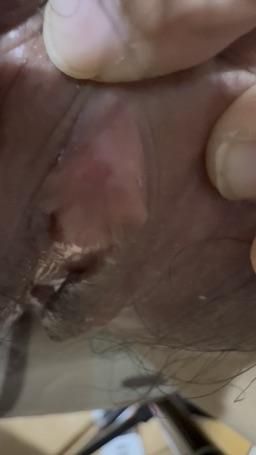 wasteful : 超近痘痘特寫